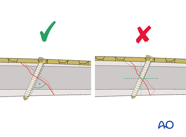 Tibial shaft simple fracture, oblique: Confirm fracture plane
