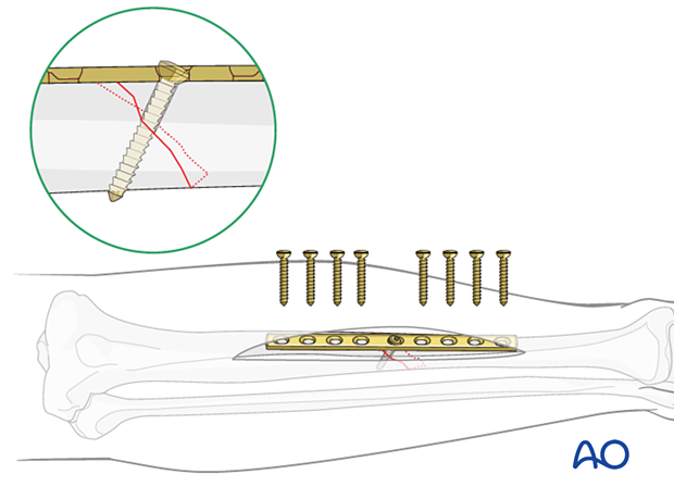 Tibial shaft simple fracture, oblique: Plate selection and preparation