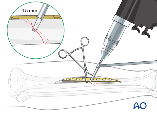 Tibial shaft simple fracture, oblique: Drilling the gliding hole for the lag screw