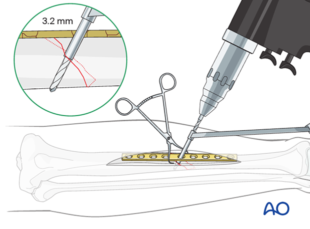 Tibial shaft simple fracture, oblique: Drilling the thread hole