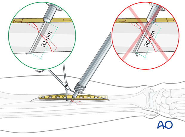Tibial shaft simple fracture, oblique: Measuring for screw length