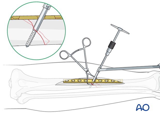 Tibial shaft simple fracture, oblique: Tapping the thread hole
