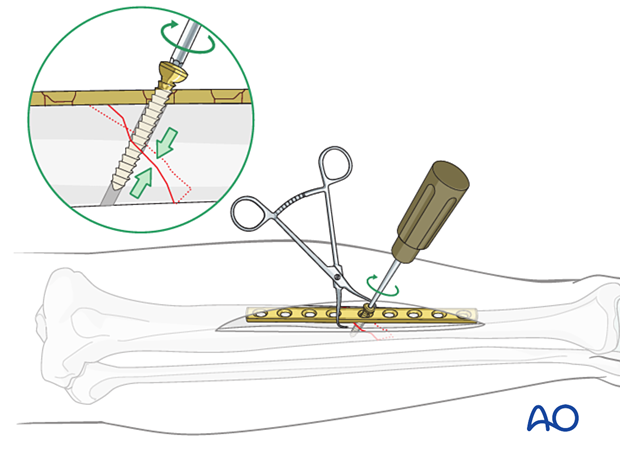 Tibial shaft simple fracture, oblique: Insertion of the lag screw