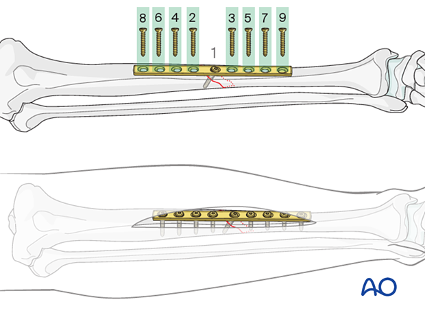Tibial shaft simple fracture, oblique: Insertion of diaphyseal fixation screws