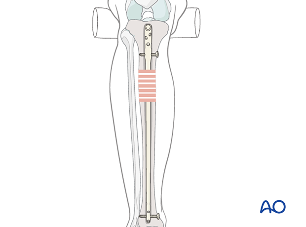 Lateral parapatellar intramedullary nailing of the tibial shaft, reaming