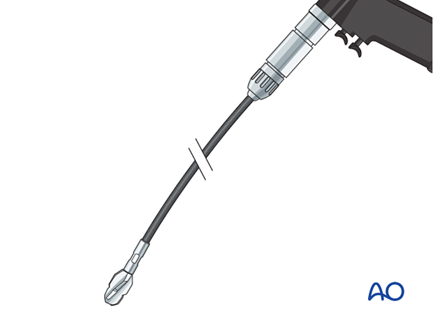 Lateral parapatellar intramedullary nailing of the tibial shaft, reaming