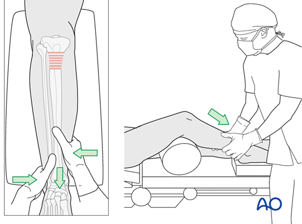 Lateral parapatellar intramedullary nailing of the tibial shaft, Reduction and preliminary fixation