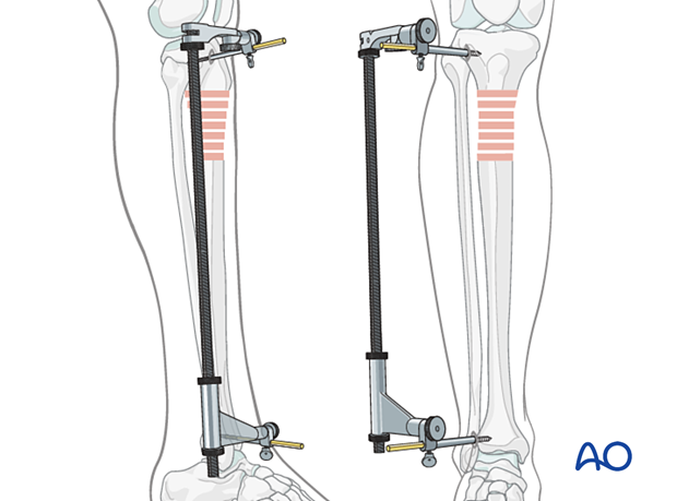 Lateral parapatellar intramedullary nailing of the tibial shaft, Reduction and preliminary fixation