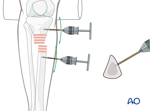 Lateral parapatellar intramedullary nailing of the tibial shaft, Reduction and preliminary fixation
