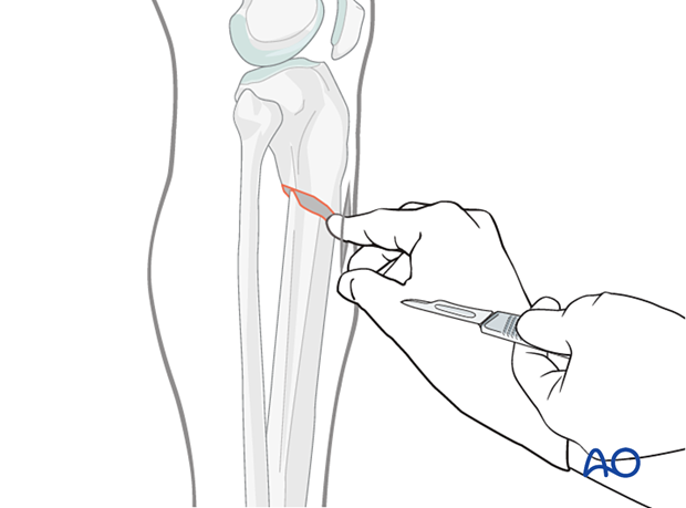 Lateral parapatellar intramedullary nailing of the tibial shaft, Reduction and preliminary fixation