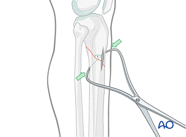 Lateral parapatellar intramedullary nailing of the tibial shaft, Reduction and preliminary fixation