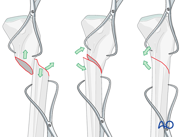 Lateral parapatellar intramedullary nailing of the tibial shaft, Reduction and preliminary fixation