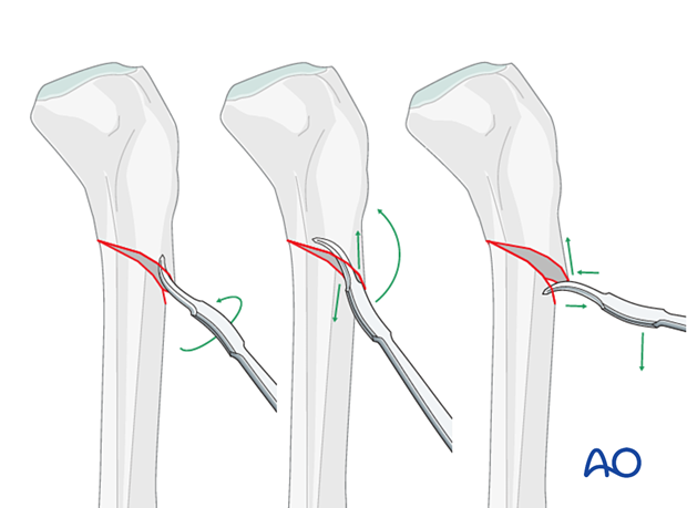 Lateral parapatellar intramedullary nailing of the tibial shaft, Reduction and preliminary fixation