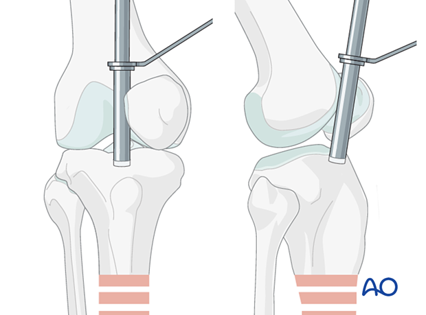 Lateral parapatellar intramedullary nailing of the tibial shaft, Nail entry site