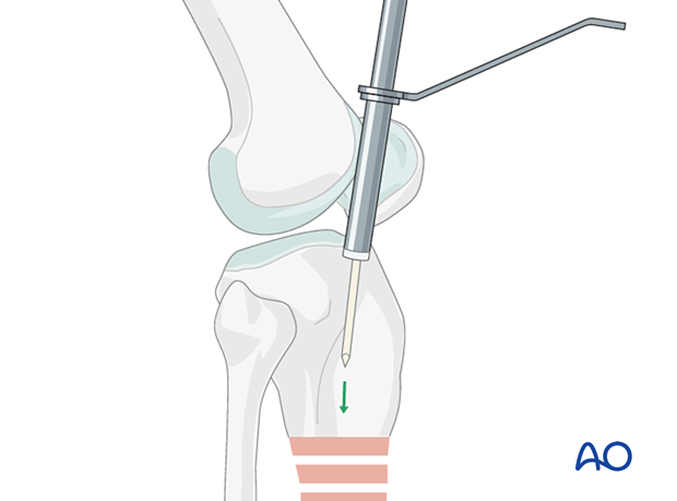 Lateral parapatellar intramedullary nailing of the tibial shaft, Nail entry site