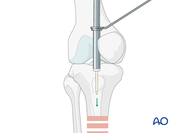 Lateral parapatellar intramedullary nailing of the tibial shaft, Nail entry site