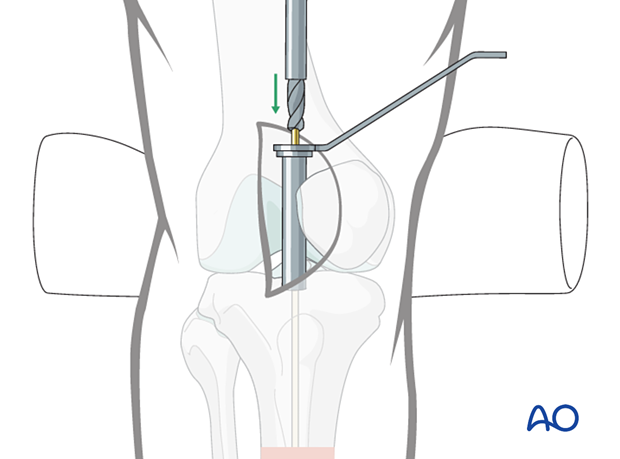 Lateral parapatellar intramedullary nailing of the tibial shaft, Nail entry site