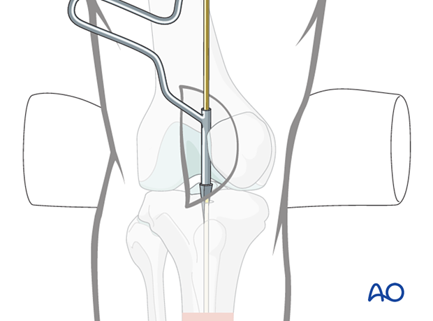 42 P140 Lateral parapatellar intramedullary nailing