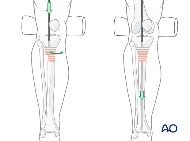 Lateral parapatellar intramedullary nailing of the tibial shaft, Guide wire insertion