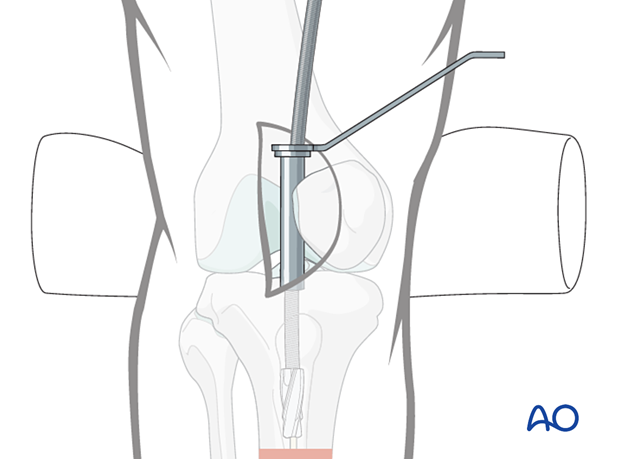 Lateral parapatellar intramedullary nailing of the tibial shaft, Nail diameter
