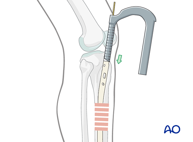 Lateral parapatellar intramedullary nailing of the tibial shaft, Cannulated nail