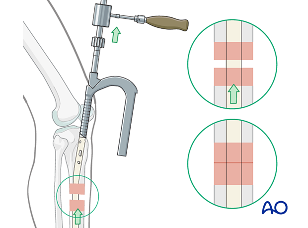 Lateral parapatellar intramedullary nailing of the tibial shaft, Cannulated nail