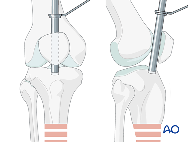 Suprapatellar intramedullary nailing, Tool for opening the bone