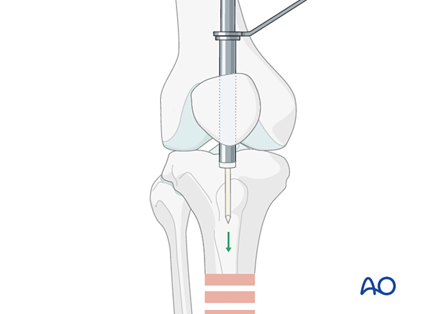 Suprapatellar intramedullary nailing, Insertion of the guide wire