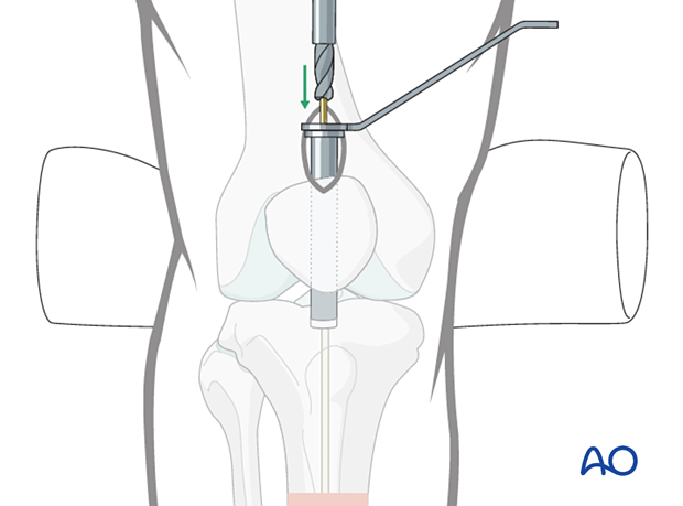 opening the cortex and proximal tibia