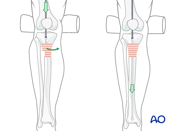 Suprapatellar intramedullary nailing, ball-tipped guide wire