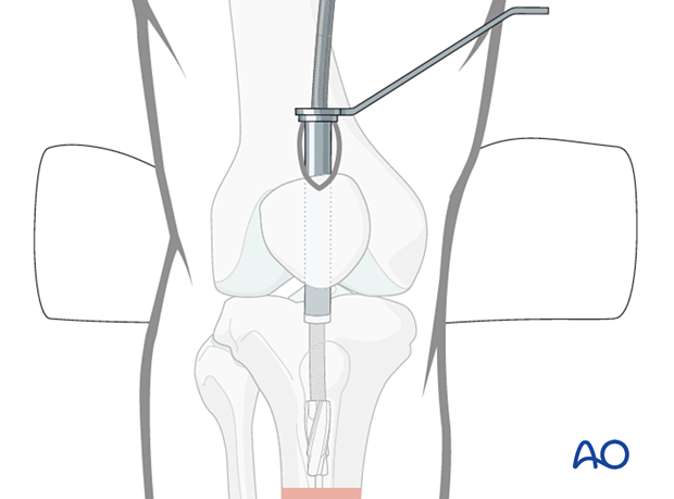 Suprapatellar intramedullary nailing, reaming and determination of nail diameter
