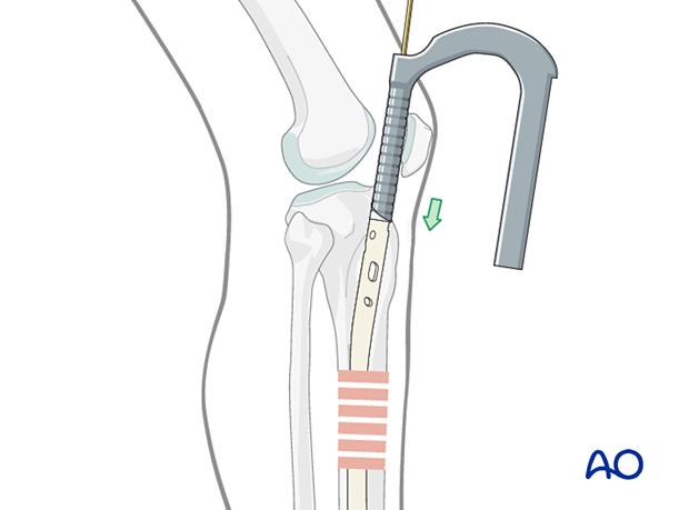 Suprapatellar intramedullary nailing, insertion of cannulated nail