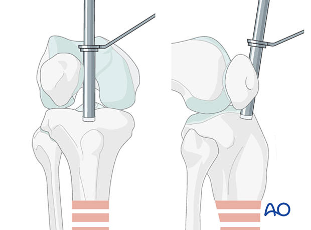 Medial parapatellar IM nailing, tools for opening the bone