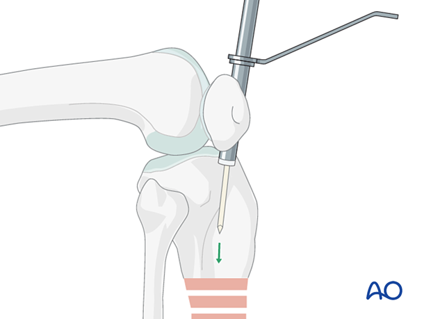 Medial parapatellar IM nailing, Insertion of guide wire