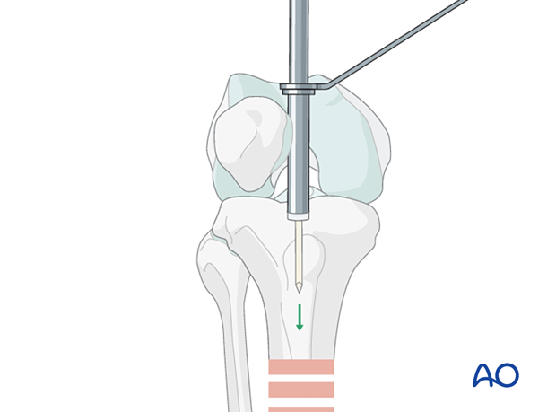 Medial parapatellar IM nailing, Insertion of guide wire