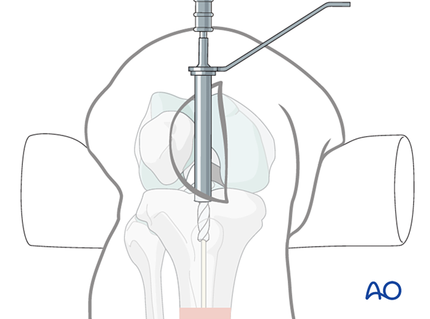 Medial parapatellar IM nailing, opening the cortex and proximal tibia