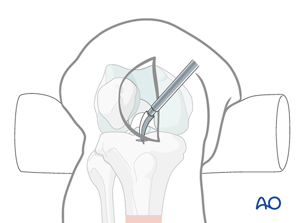 Medial parapatellar IM nailing, Curved solid awl