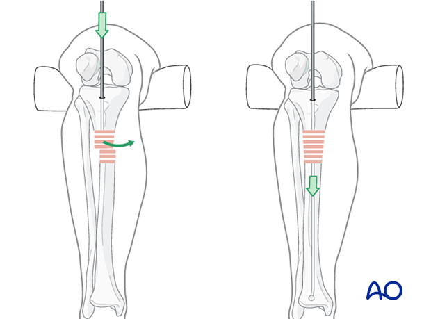 Medial parapatellar IM nailing, Ball-tipped guide wire