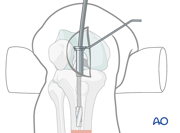 Medial parapatellar IM nailing, Reaming