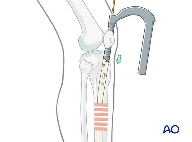Medial parapatellar IM nailing, nail insertion