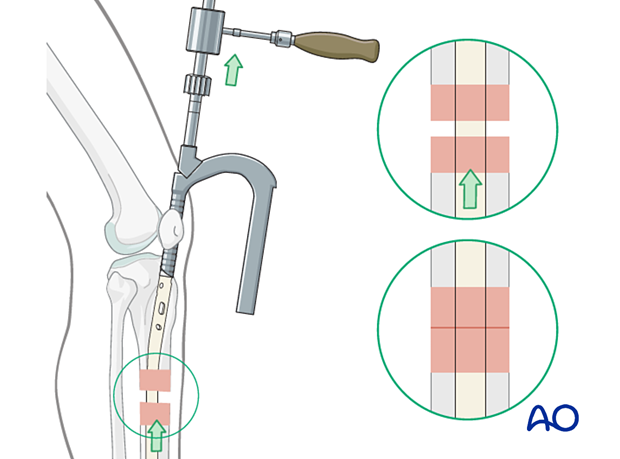 Medial parapatellar IM nailing, Backslap technique for correction of fragment diastasis