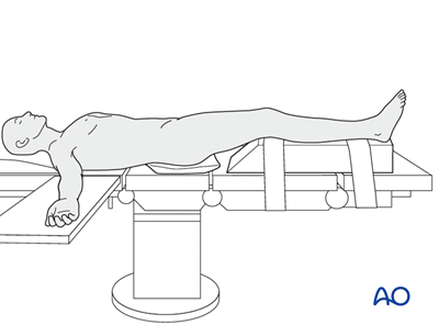 ORIF - Lag screws through protection plate for Simple fracture, spiral