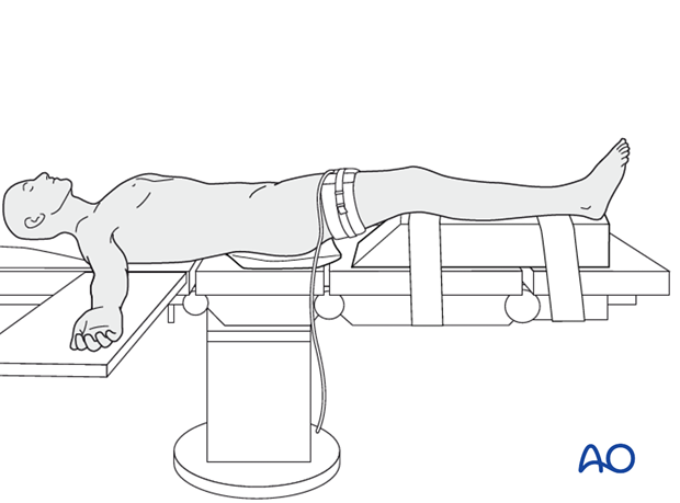 Supine patient positioning and portal designation. (A) Supine position