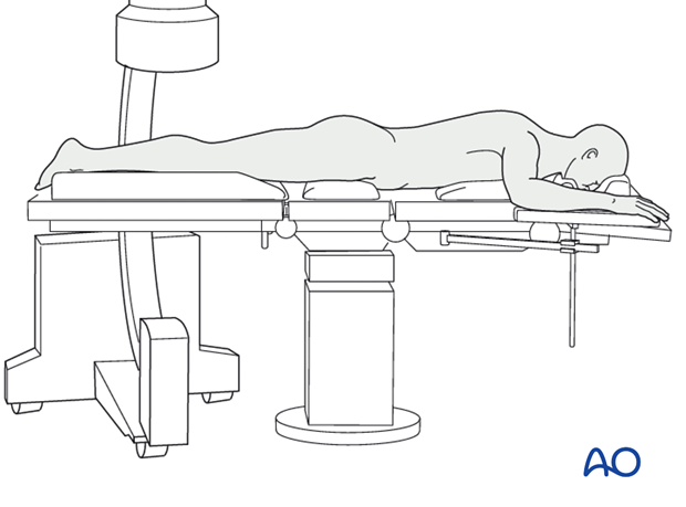 Prone position with C-arm