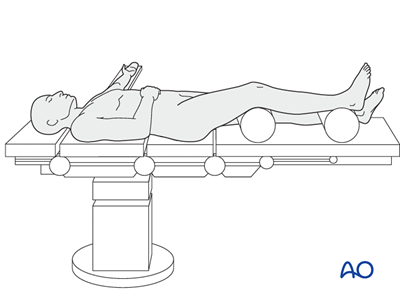 Ring fixator (Ilizarov) for Simple fracture, oblique