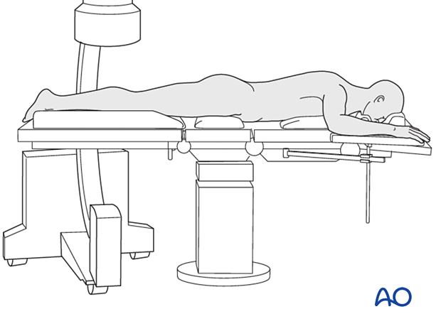 42_Pr010_i020 Prone position with C-arm