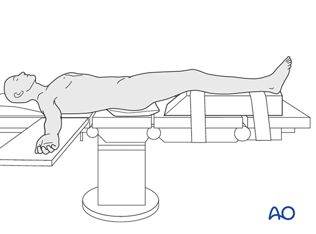 orif compression plating
