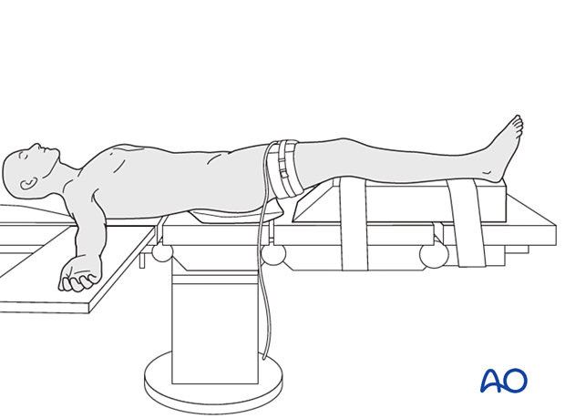 42_Pr020_i020 Supine position with tourniquet
