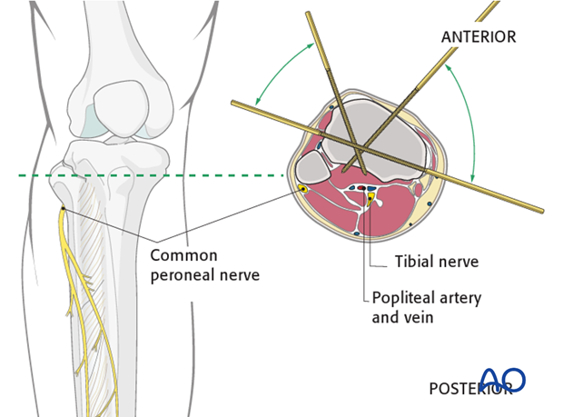 Tibia Fractures: Ilizarov / Circular Wire Fixators : Wheeless' Textbook of  Orthopaedics