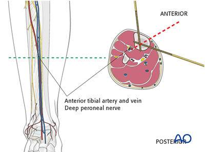 Safe Zones In The Tibia For Pin Insertion